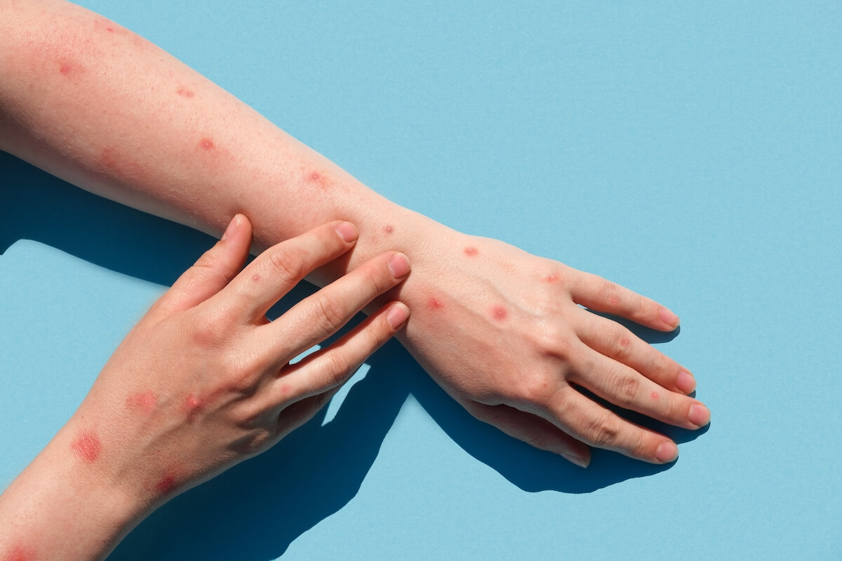 Monkeypox: Opportunity to learn from Islamic health protective system